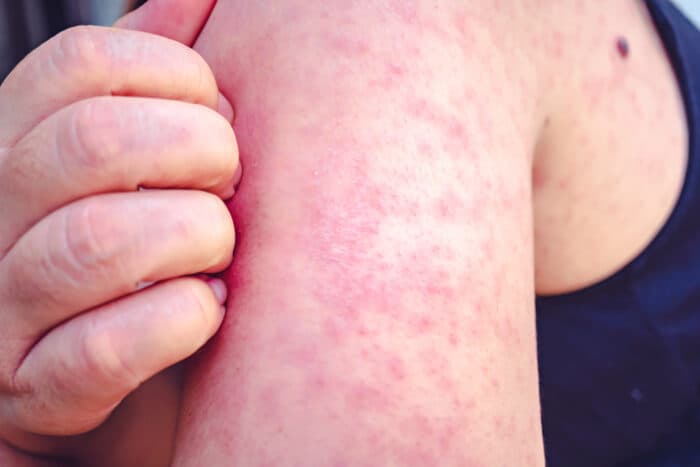Health Officials Respond to Measles Outbreaks Across Ohio