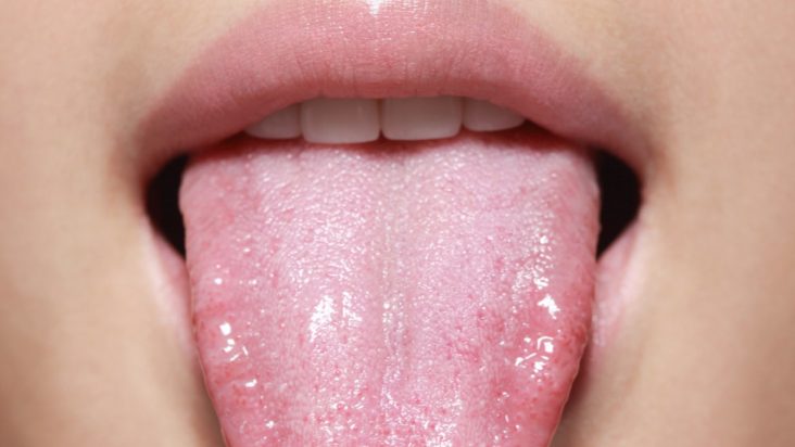 Bumps on Back of Tongue