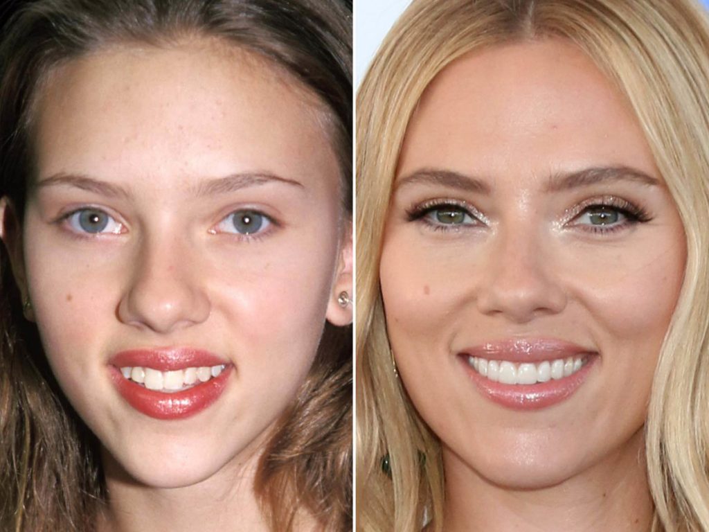 Scarlett Johansson Plastic Surgery – Before and After Photos - Follow News