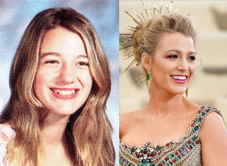 Blake Lively Boob Job Did The Actress Get A Plastic