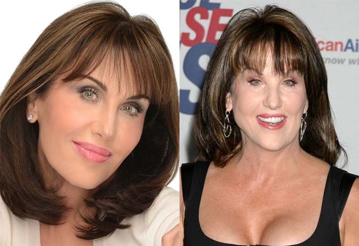 robin mcgraw after plastic surgery