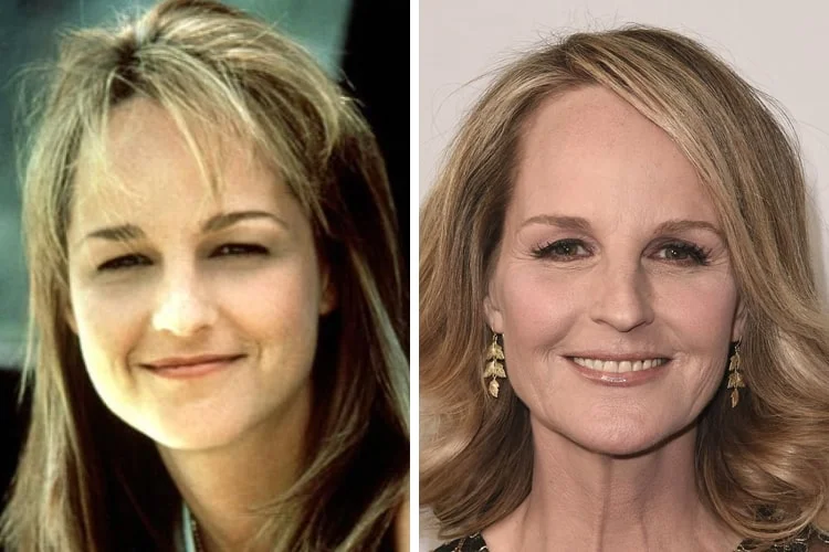 helen hunt before and after surgery face